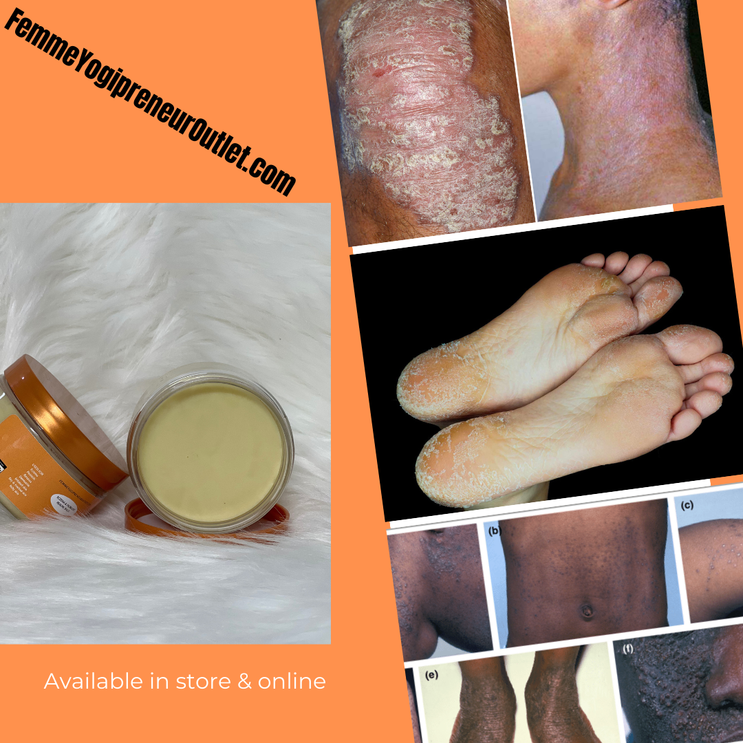 Eczema & Psoriasis Healing Balm