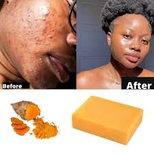 Turmeric & Kojic Soap for Face & Body - Organic & Vegan